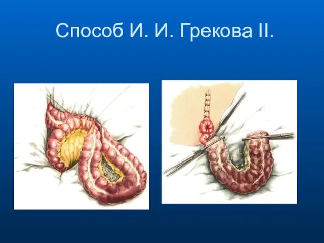 Способ И. И. Грекова II.