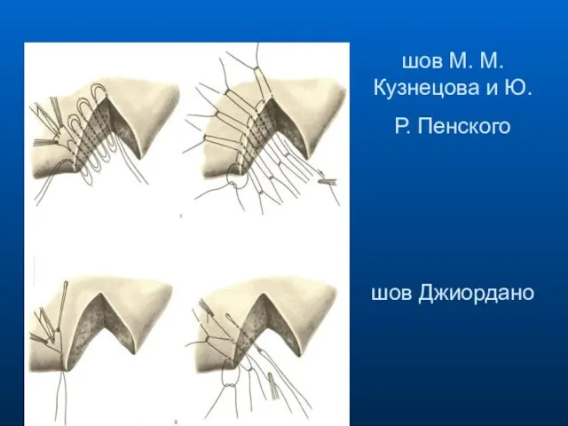 шов М. М. Кузнецова и Ю. Р. Пенского шов Джиордано