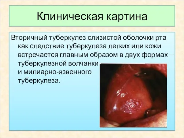 Клиническая картина Вторичный туберкулез слизистой оболочки рта как следствие туберкулеза легких