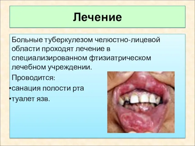 Лечение Больные туберкулезом челюстно-лицевой области проходят лечение в специализированном фтизиатрическом лечебном