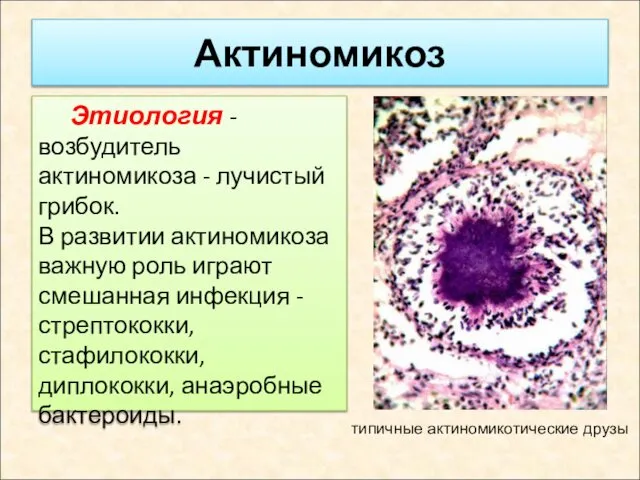 Актиномикоз Этиология - возбудитель актиномикоза - лучистый грибок. В развитии актиномикоза