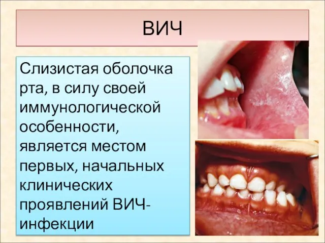 ВИЧ Слизистая оболочка рта, в силу своей иммунологической особенности, является местом первых, начальных клинических проявлений ВИЧ-инфекции