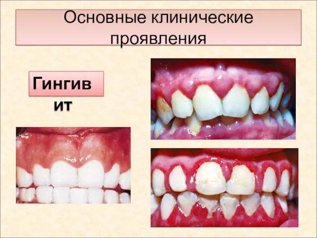 Основные клинические проявления Гингивит