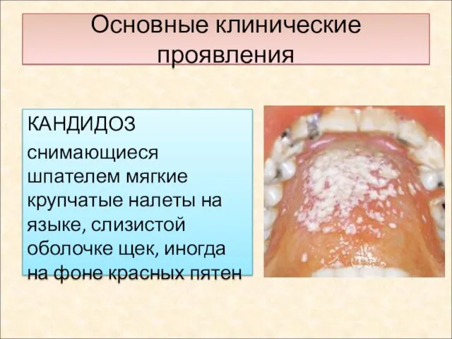 Основные клинические проявления КАНДИДОЗ снимающиеся шпателем мягкие крупчатые налеты на языке,