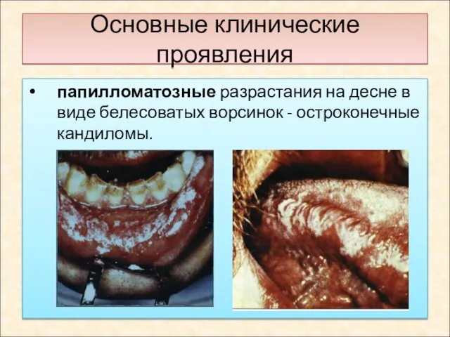 Основные клинические проявления папилломатозные разрастания на десне в виде белесоватых ворсинок - остроконечные кандиломы.