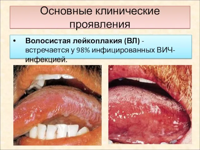 Основные клинические проявления Волосистая лейкоплакия (ВЛ) - встречается у 98% инфицированных ВИЧ-инфекцией.