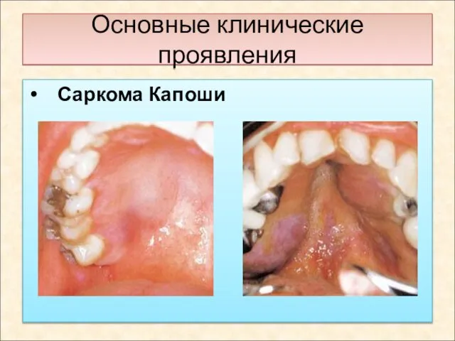 Основные клинические проявления Саркома Капоши