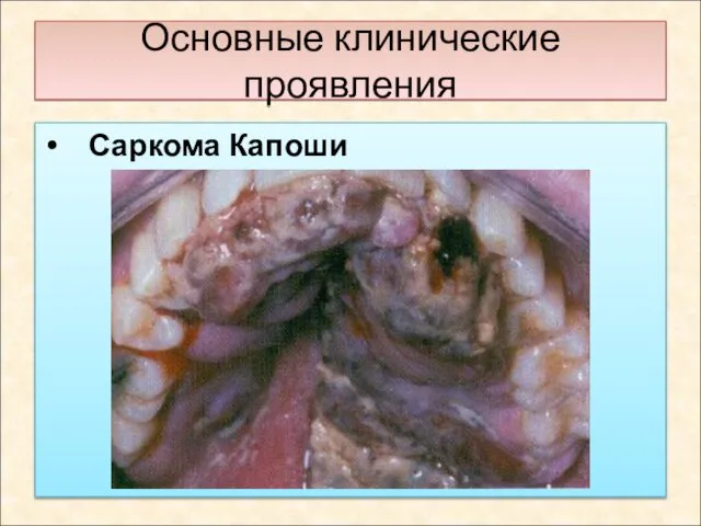 Основные клинические проявления Саркома Капоши