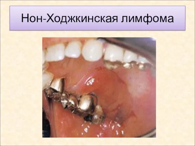 Нон-Ходжкинская лимфома