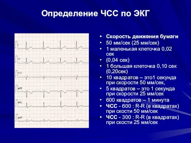 Определение ЧСС по ЭКГ Скорость движения бумаги 50 мм/сек (25 мм/сек)