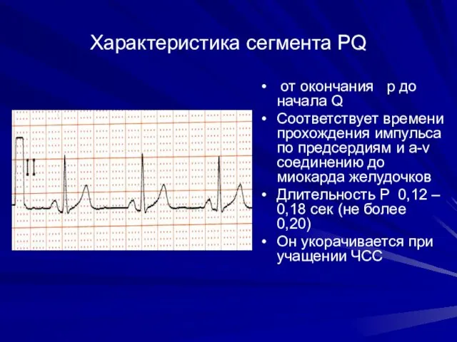 Характеристика сегмента РQ от окончания p до начала Q Соответствует времени