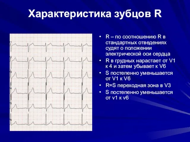 Характеристика зубцов R R – по соотношению R в стандартных отведениях