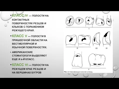 КЛАСС IV — ПОЛОСТИ НА КОНТАКТНЫХ ПОВЕРХНОСТЯХ РЕЗЦОВ И КЛЫКОВ С