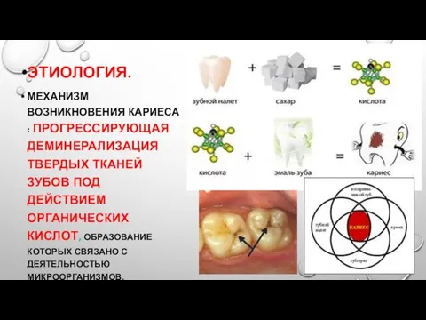 ЭТИОЛОГИЯ. МЕХАНИЗМ ВОЗНИКНОВЕНИЯ КАРИЕСА : ПРОГРЕССИРУЮЩАЯ ДЕМИНЕРАЛИЗАЦИЯ ТВЕРДЫХ ТКАНЕЙ ЗУБОВ ПОД