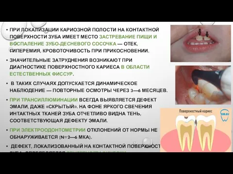 ПРИ ЛОКАЛИЗАЦИИ КАРИОЗНОЙ ПОЛОСТИ НА КОНТАКТНОЙ ПОВЕРХНОСТИ ЗУБА ИМЕЕТ МЕСТО ЗАСТРЕВАНИЕ