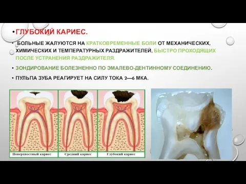 ГЛУБОКИЙ КАРИЕС. БОЛЬНЫЕ ЖАЛУЮТСЯ НА КРАТКОВРЕМЕННЫЕ БОЛИ ОТ МЕХАНИЧЕСКИХ, ХИМИЧЕСКИХ И