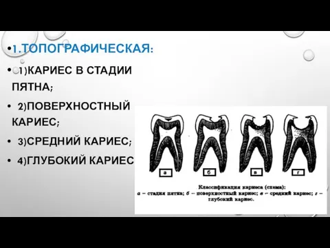 1.ТОПОГРАФИЧЕСКАЯ: 1)КАРИЕС В СТАДИИ ПЯТНА; 2)ПОВЕРХНОСТНЫЙ КАРИЕС; 3)СРЕДНИЙ КАРИЕС; 4)ГЛУБОКИЙ КАРИЕС.