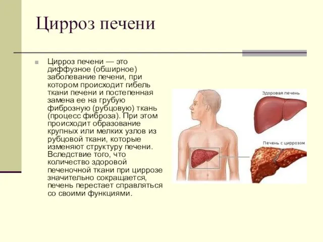 Цирроз печени Цирроз печени — это диффузное (обширное) заболевание печени, при