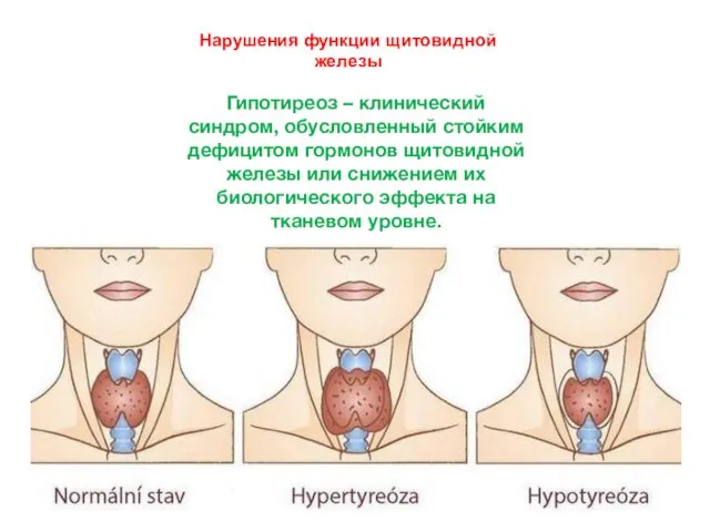 Нарушения функции щитовидной железы Гипотиреоз – клинический синдром, обусловленный стойким дефицитом