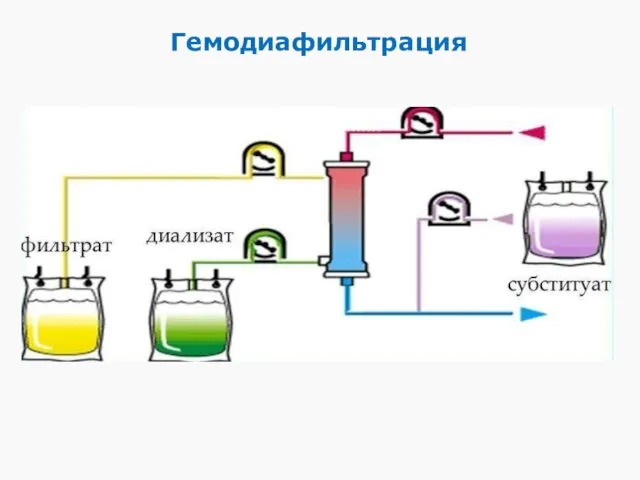 Гемодиафильтрация