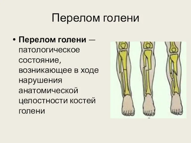 Перелом голени Перелом голени — патологическое состояние, возникающее в ходе нарушения анатомической целостности костей голени