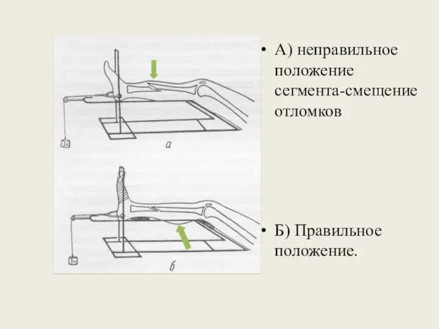 А) неправильное положение сегмента-смещение отломков Б) Правильное положение.