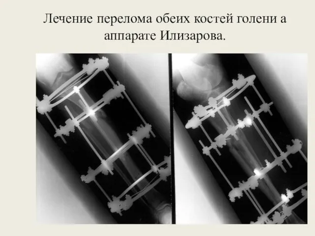 Лечение перелома обеих костей голени а аппарате Илизарова.