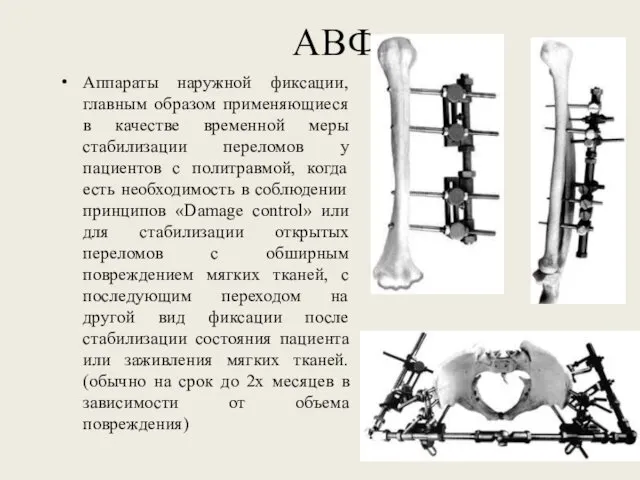 АВФ Аппараты наружной фиксации, главным образом применяющиеся в качестве временной меры