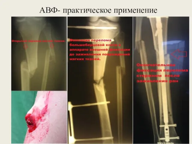 АВФ- практическое применение