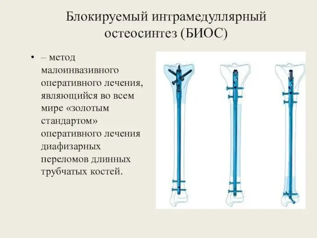 Блокируемый интрамедуллярный остеосинтез (БИОС) – метод малоинвазивного оперативного лечения, являющийся во