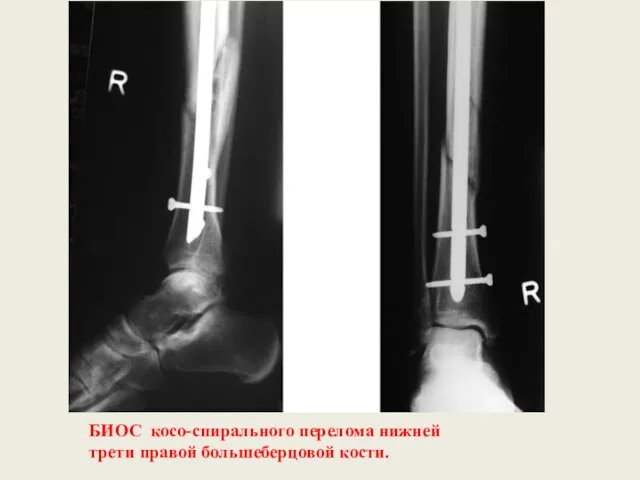 БИОС косо-спирального перелома нижней трети правой большеберцовой кости.
