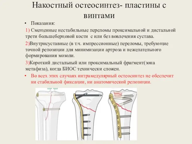 Накостный остеосинтез- пластины с винтами Показания: 1) Смещенные нестабильные переломы проксимальной