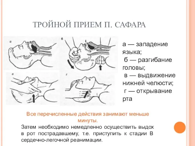 ТРОЙНОЙ ПРИЕМ П. САФАРА а — западение языка; б — разгибание