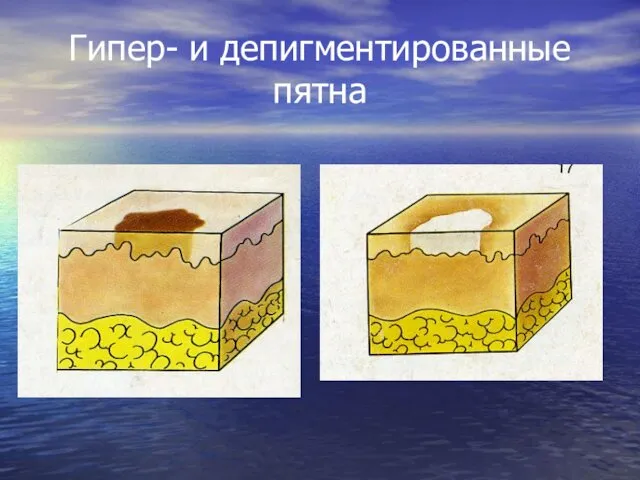 Гипер- и депигментированные пятна