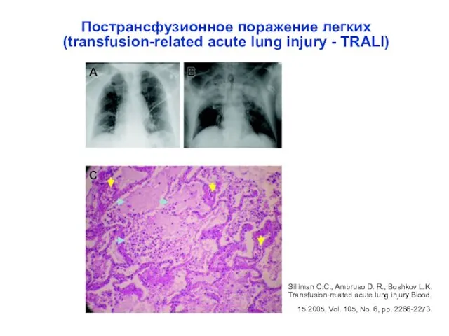 Пострансфузионное поражение легких (transfusion-related acute lung injury - TRALI) Silliman C.C.,