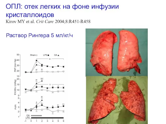 ОПЛ: отек легких на фоне инфузии кристаллоидов Kirov MY et al.