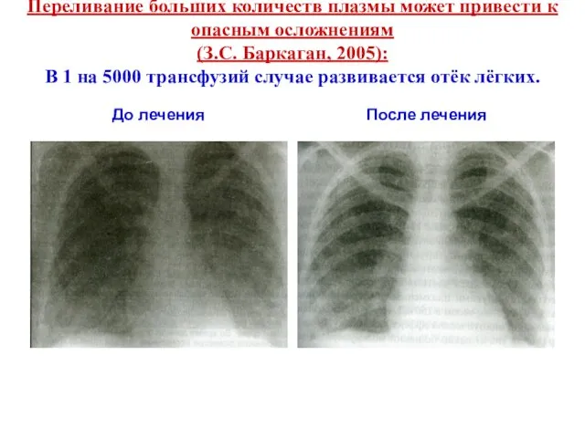 Пеpеливание больших количеств плазмы может пpивести к опасным осложнениям (З.С. Баркаган,