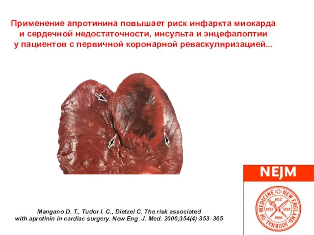 Применение апротинина повышает риск инфаркта миокарда и сердечной недостаточности, инсульта и