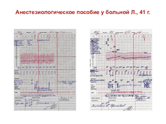 Анестезиологическое пособие у больной Л., 41 г.