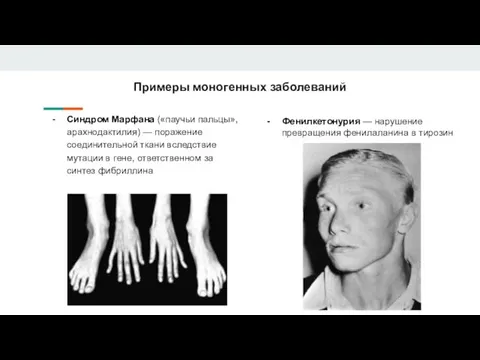 Примеры моногенных заболеваний Синдром Марфана («паучьи пальцы», арахнодактилия) — поражение соединительной