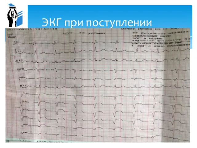 ЭКГ при поступлении