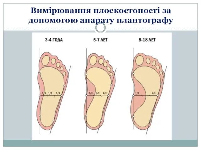 Вимірювання плоскостопості за допомогою апарату плантографу