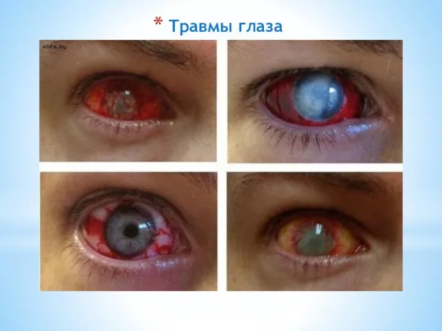 Травмы глаза