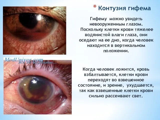 Гифему можно увидеть невооруженным глазом. Поскольку клетки крови тяжелее водянистой влаги