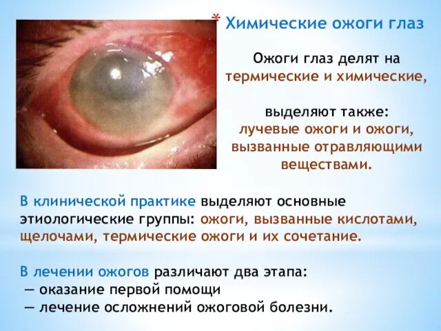 Химические ожоги глаз Ожоги глаз делят на термические и химические, выделяют