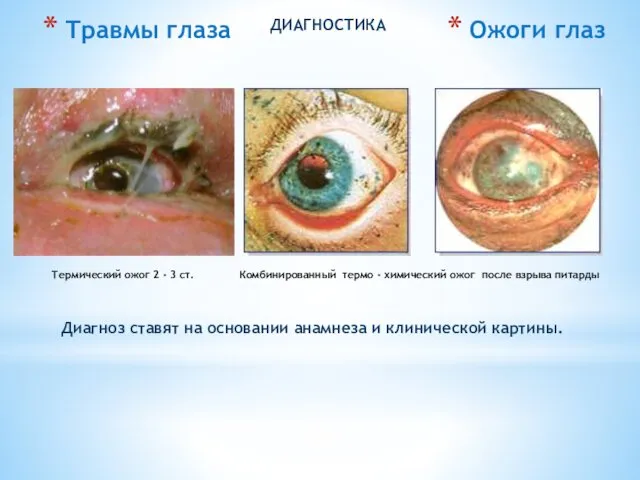 Диагноз ставят на основании анамнеза и клинической картины. ДИАГНОСТИКА Ожоги глаз