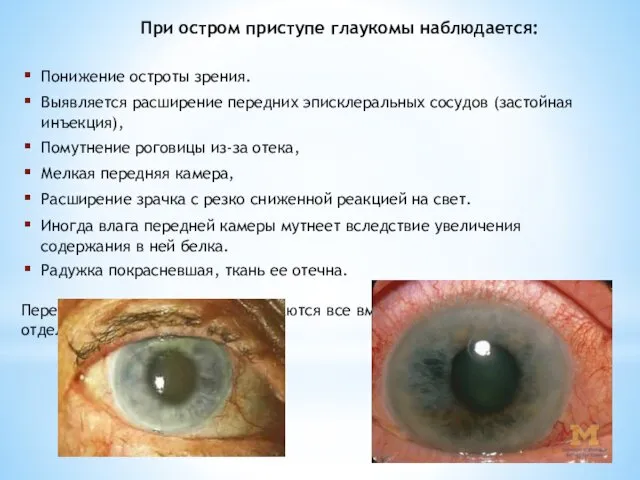 Понижение остроты зрения. Выявляется расширение передних эписклеральных сосудов (застойная инъекция), Помутнение