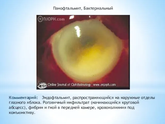 Панофтальмит, Бактериальный Комментарий: Эндофтальмит, распространяющийся на наружные отделы глазного яблока. Роговичный