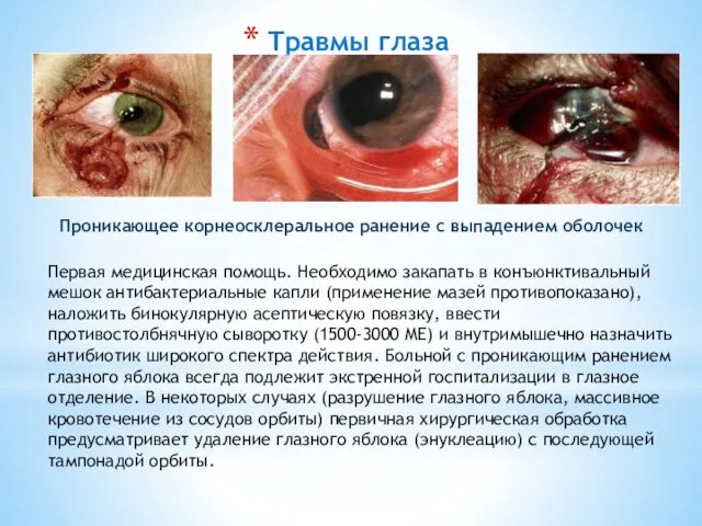Травмы глаза Первая медицинская помощь. Необходимо закапать в конъюнктивальный мешок антибактериальные