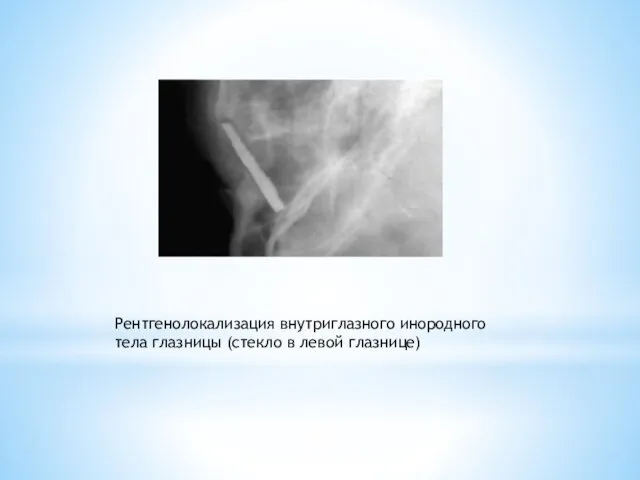 Рентгенолокализация внутриглазного инородного тела глазницы (стекло в левой глазнице)